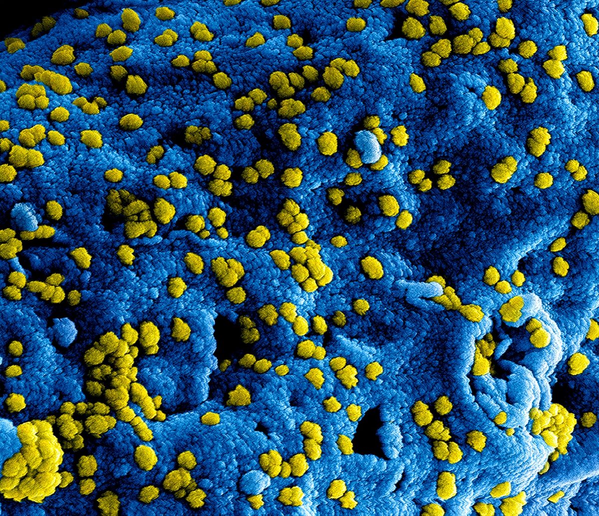 Una imagen en primer plano de un virus bajo el microscopio que recuerda al agua hidrogenada. La superficie tiene una textura de un azul vibrante, salpicada de pequeñas esferas amarillas que representan partículas virales esparcidas por la superficie azul.