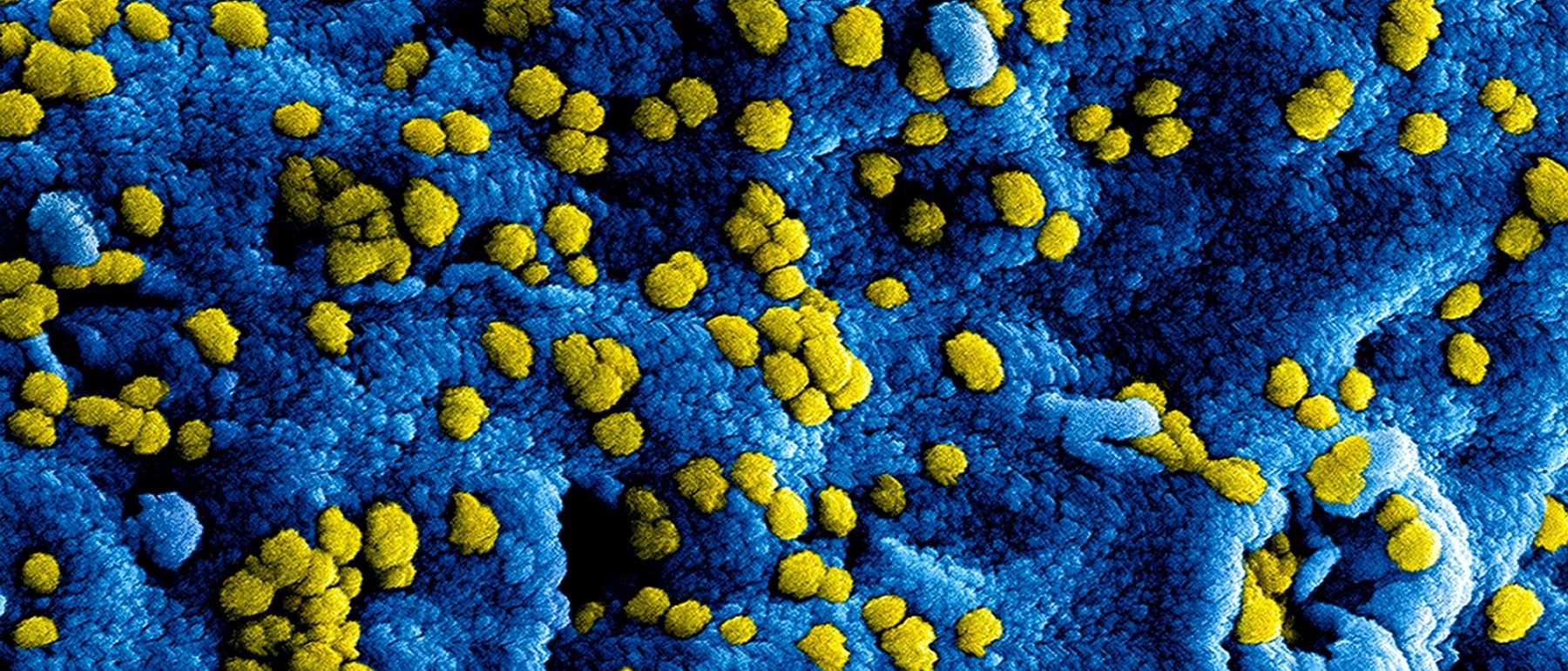 Una imagen en primer plano de un virus bajo el microscopio que recuerda al agua hidrogenada. La superficie tiene una textura de un azul vibrante, salpicada de pequeñas esferas amarillas que representan partículas virales esparcidas por la superficie azul.